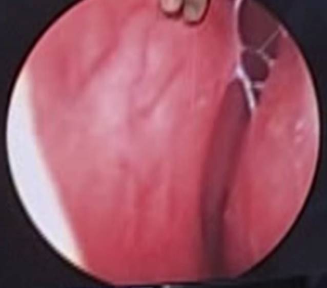 Regenerative restoration of Prof. Liu’s nasal mucosa (After)